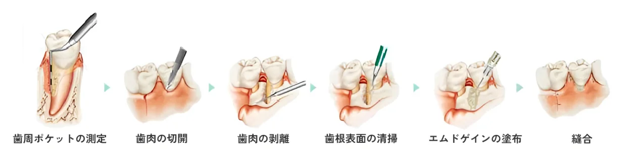 歯周ポケットの測定→歯肉の切開→歯肉の剥離→歯根表面の清掃→エム度ゲインの塗布→縫合